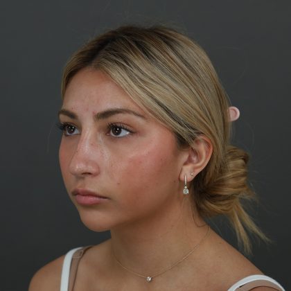 Rhinoplasty Before & After Patient #9987