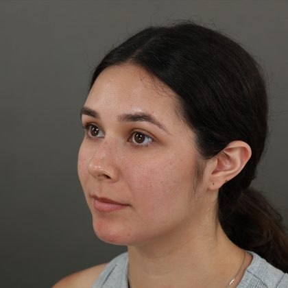 Rhinoplasty Before & After Patient #9988