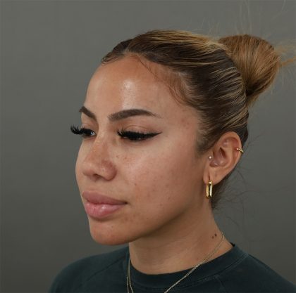 Rhinoplasty Before & After Patient #9990