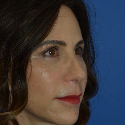 Regenelift™ Facelift Before & After Patient #9993