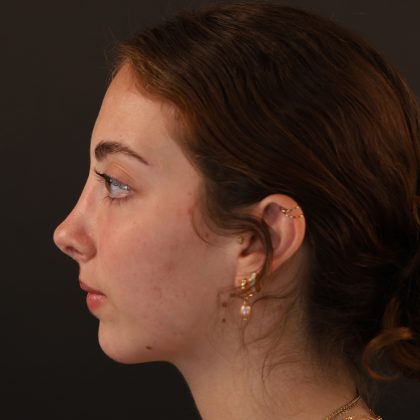 Rhinoplasty Before & After Patient #9996