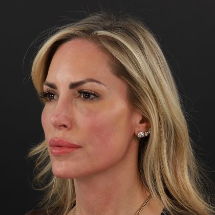Rhinoplasty Before & After Patient #9997