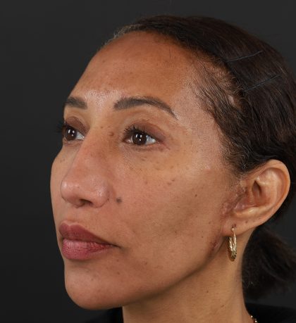 Regenelift™ Facelift Before & After Patient #9998