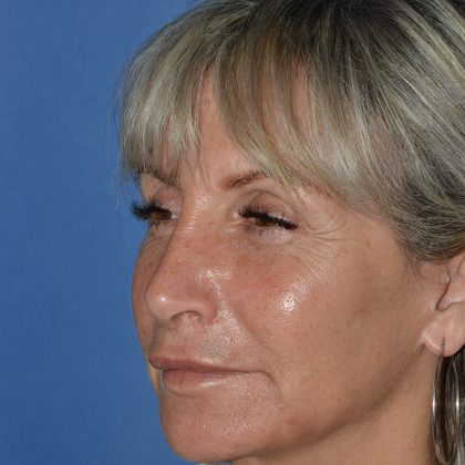 Regenelift™ Facelift Before & After Patient #9786