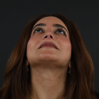 Regenelift™ Facelift Before & After Patient #9788