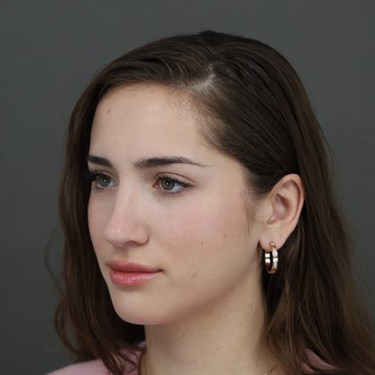 Rhinoplasty Before & After Patient #9790