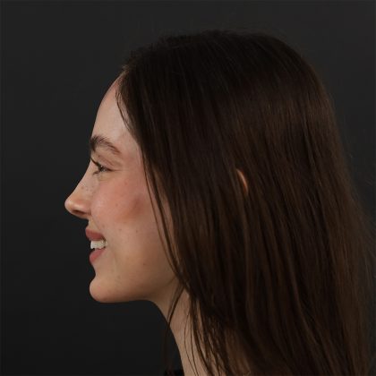 Rhinoplasty Before & After Patient #9783