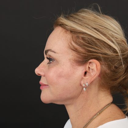 Regenelift™ Facelift Before & After Patient #9793