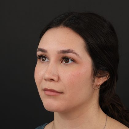 Rhinoplasty Before & After Patient #9988