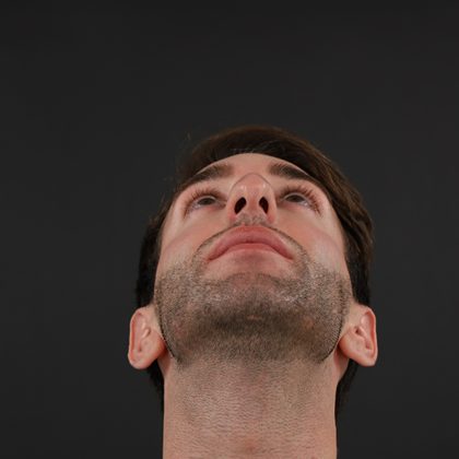 Rhinoplasty Before & After Patient #9785