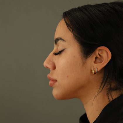 Rhinoplasty Before & After Patient #9990