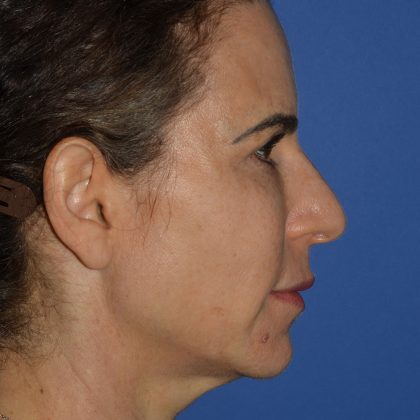Regenelift™ Facelift Before & After Patient #9993