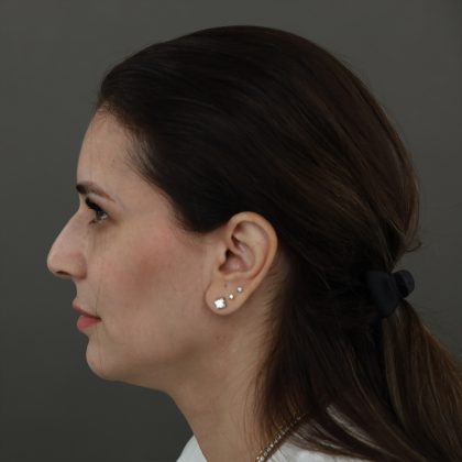 Rhinoplasty Before & After Patient #9994