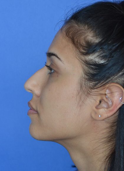 Rhinoplasty Before & After Patient #9995