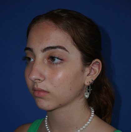Rhinoplasty Before & After Patient #9996