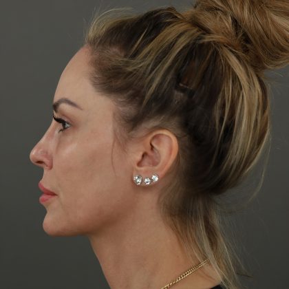 Rhinoplasty Before & After Patient #9997