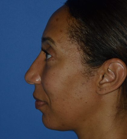 Regenelift™ Facelift Before & After Patient #9998