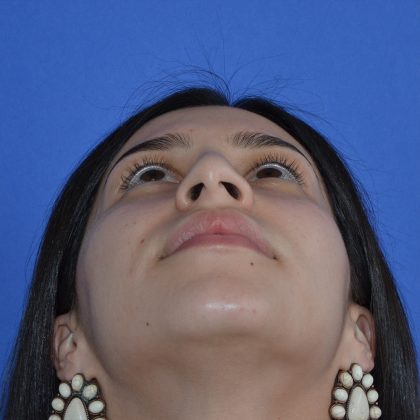 Rhinoplasty Before & After Patient #9999