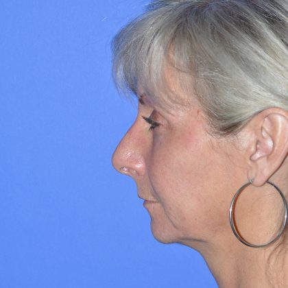 Regenelift™ Facelift Before & After Patient #9786
