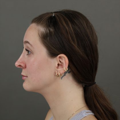 Rhinoplasty Before & After Patient #10000