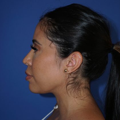 Browlift Before & After Patient #10001