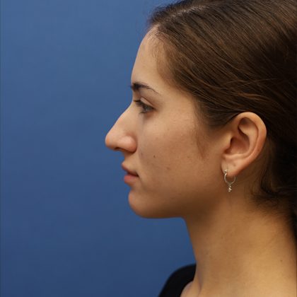 Rhinoplasty Before & After Patient #9790