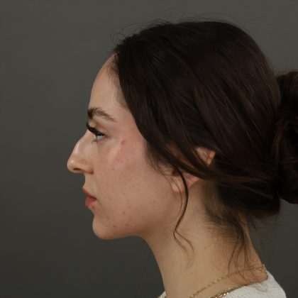 Rhinoplasty Before & After Patient #9783