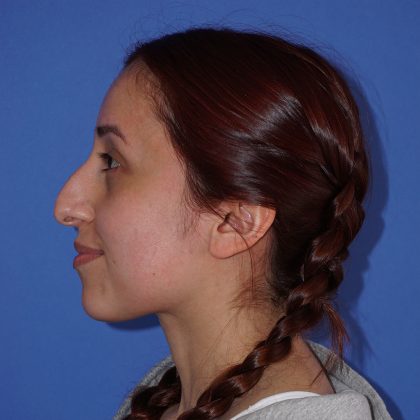 Rhinoplasty Before & After Patient #9791