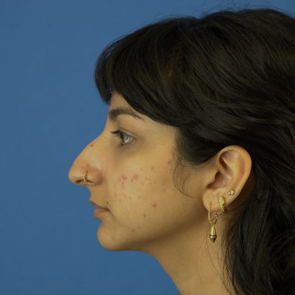 Rhinoplasty Before & After Patient #9986