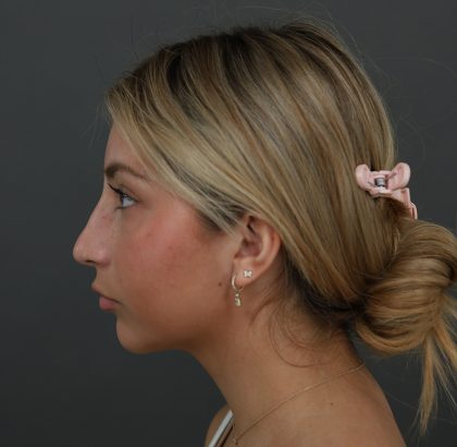 Rhinoplasty Before & After Patient #9987