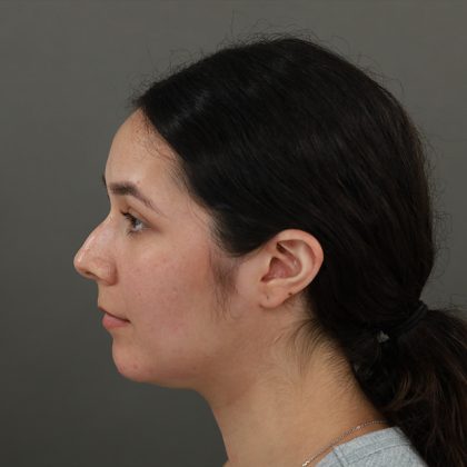 Rhinoplasty Before & After Patient #9988