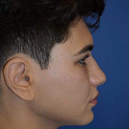 Rhinoplasty Before & After Patient #9989
