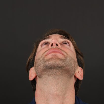 Rhinoplasty Before & After Patient #9785