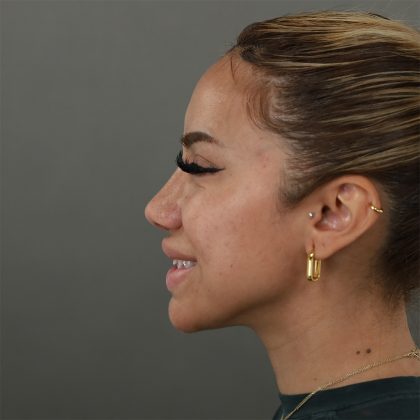 Rhinoplasty Before & After Patient #9990