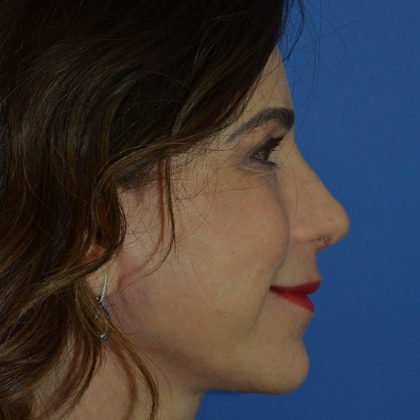 Regenelift™ Facelift Before & After Patient #9993
