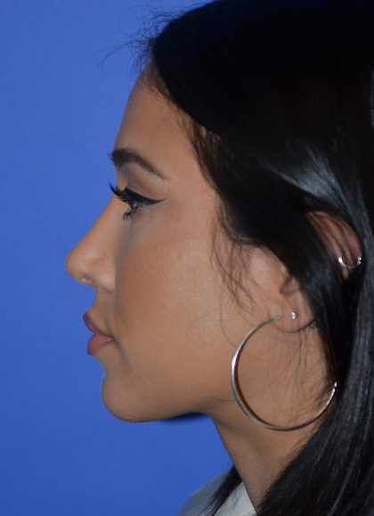 Rhinoplasty Before & After Patient #9995