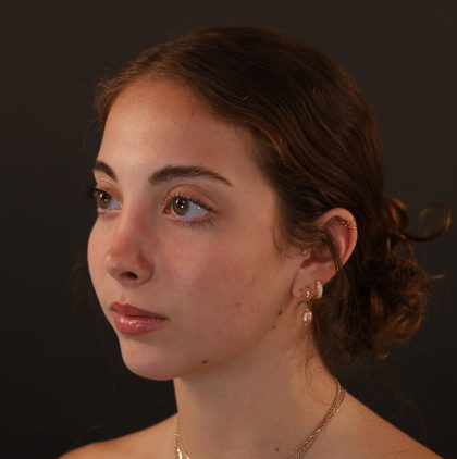 Rhinoplasty Before & After Patient #9996