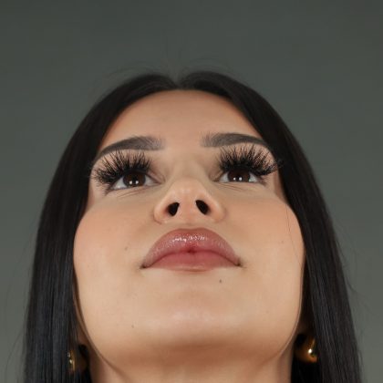 Rhinoplasty Before & After Patient #9999