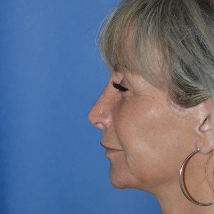Regenelift™ Facelift Before & After Patient #9786