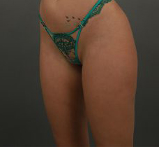 Buttock Augmentation Before & After Patient #9992