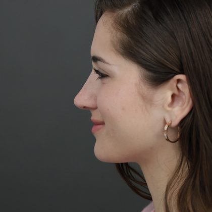 Rhinoplasty Before & After Patient #9790
