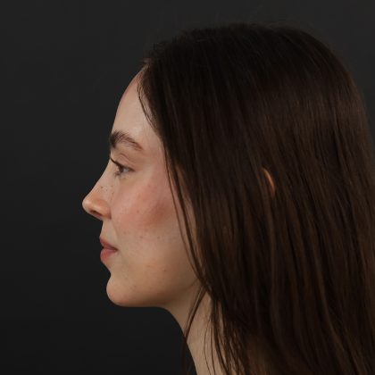 Rhinoplasty Before & After Patient #9783