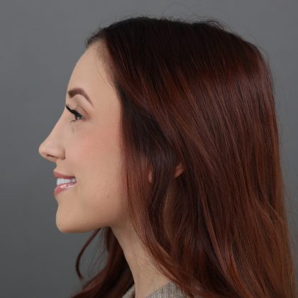 Rhinoplasty Before & After Patient #9791