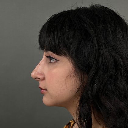 Rhinoplasty Before & After Patient #9986