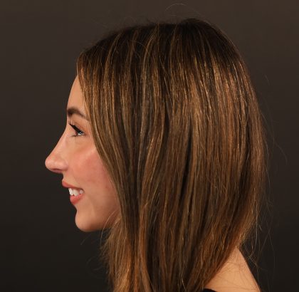 Rhinoplasty Before & After Patient #9987