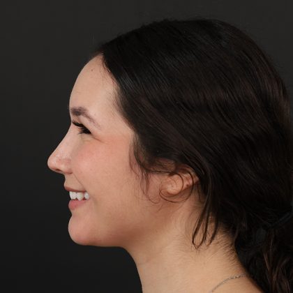 Rhinoplasty Before & After Patient #9988