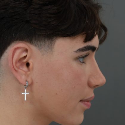 Rhinoplasty Before & After Patient #9989