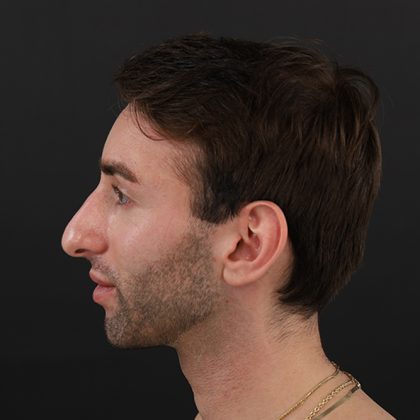 Rhinoplasty Before & After Patient #9785