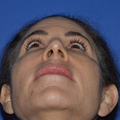 Regenelift™ Facelift Before & After Patient #9993