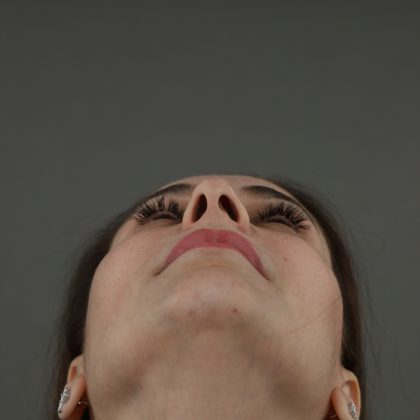 Rhinoplasty Before & After Patient #9994